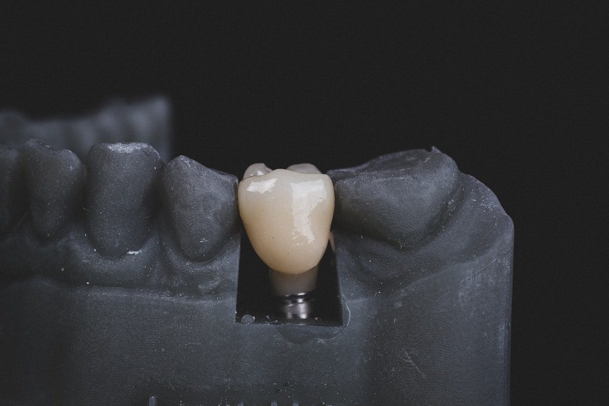  Image of a teeth model showing dental implant Best Majors For Dental School